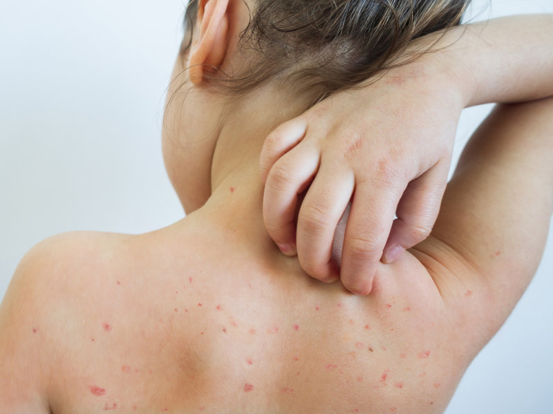 Measles Outbreak Scares New Yorkers